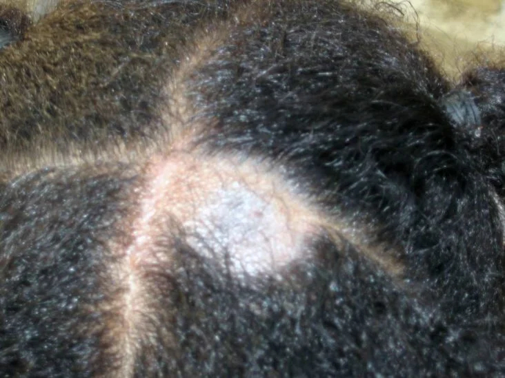 alopecia-areata-in-a-young-black-patient.jpg