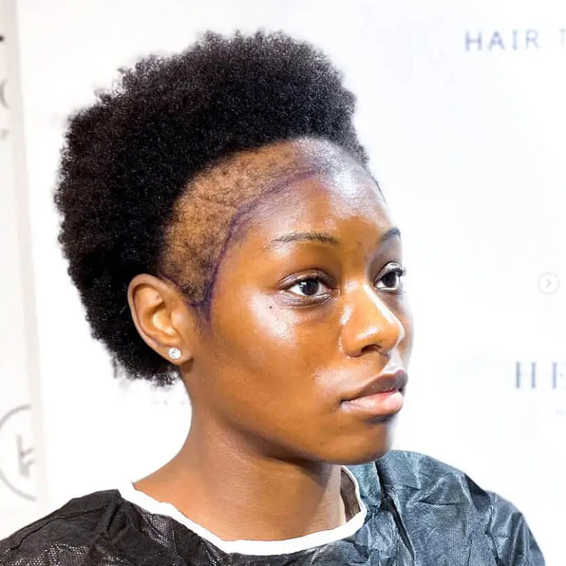 Afro-female-hair-loss-before-hair-transplant (1)