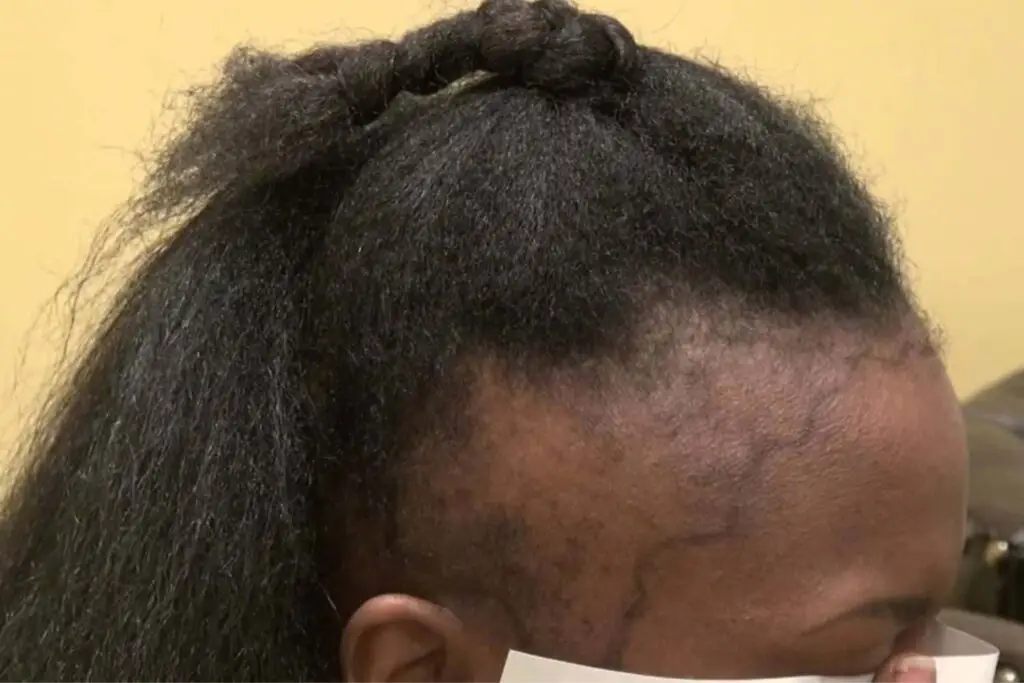 Hairline-treatment (1)